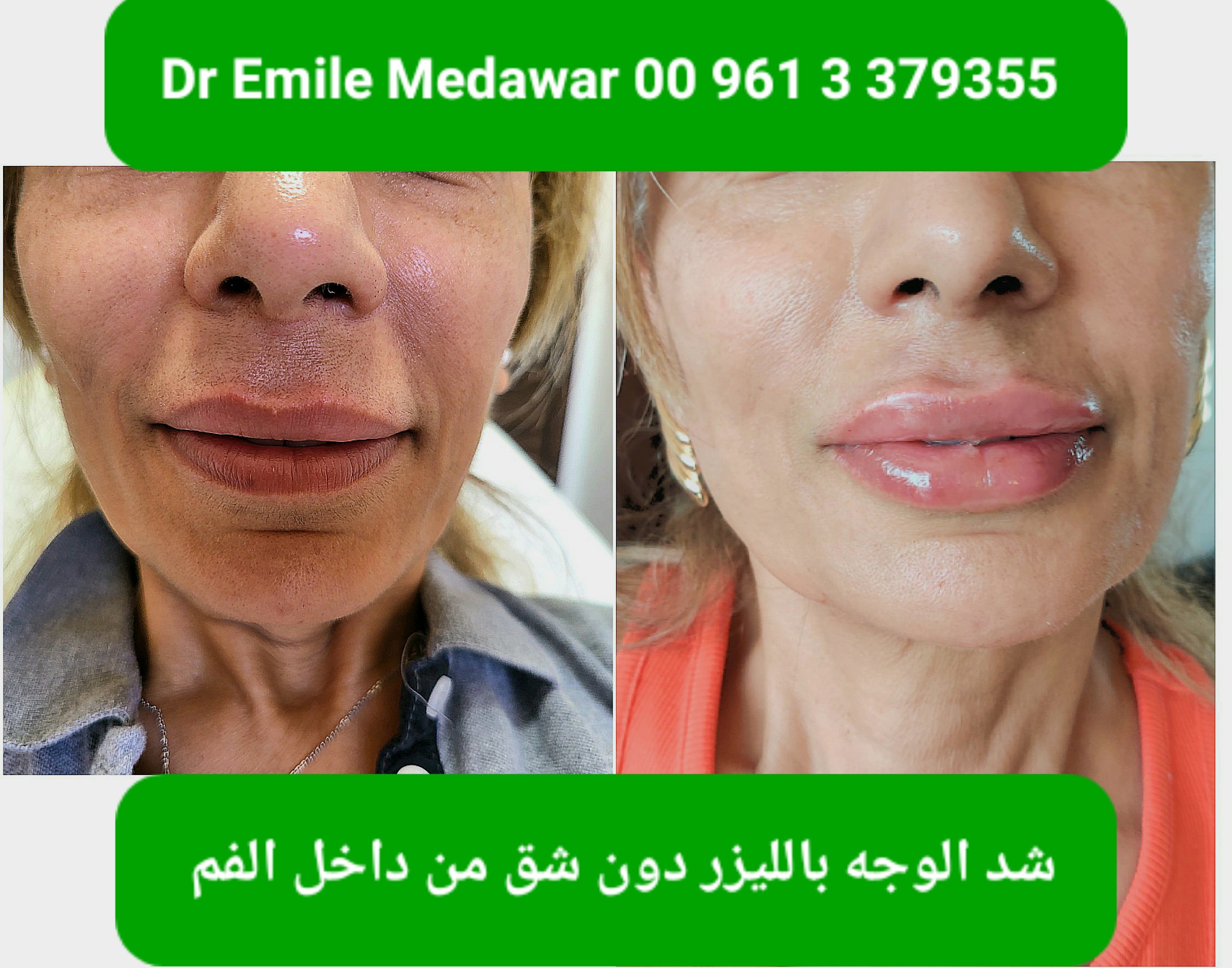 Non Surgical Face Lift Beirut