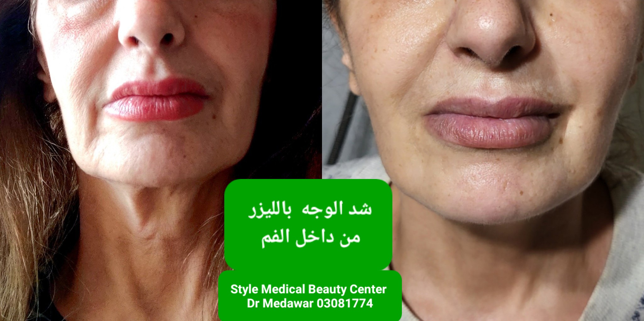 Laser CO2 Skin Tightening Lebanon