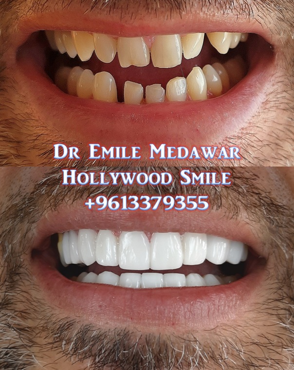 veneers in lebanon beirut