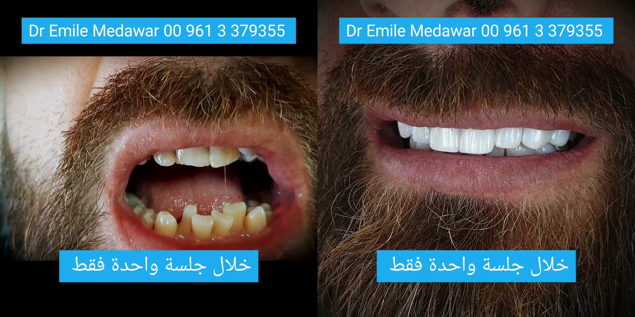 dental implants Lebanon beirut