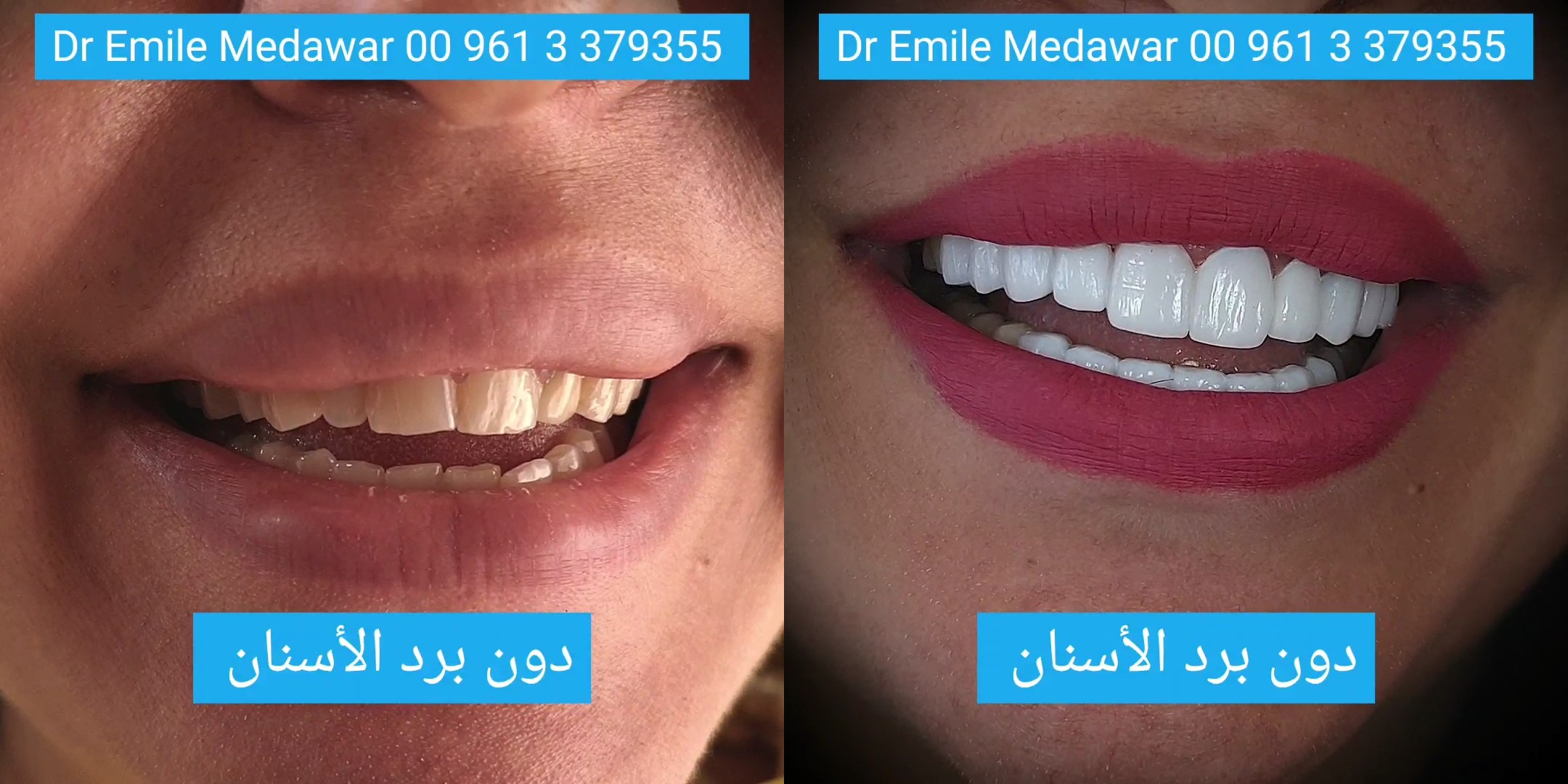 best dental  implants in lebanon beirut