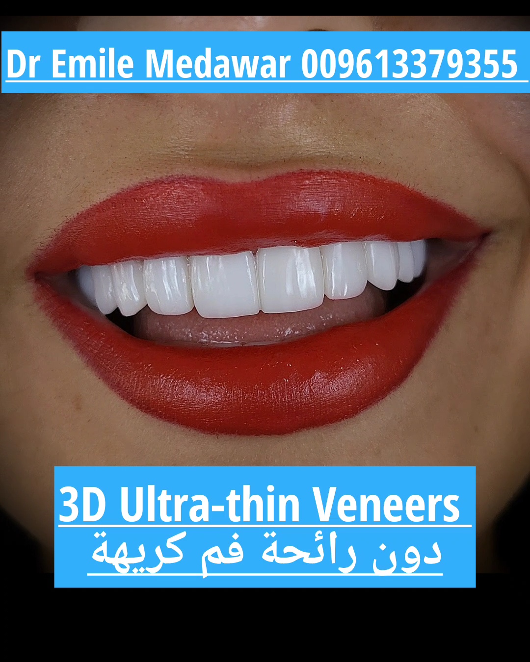 best veneers in lebanon beirut