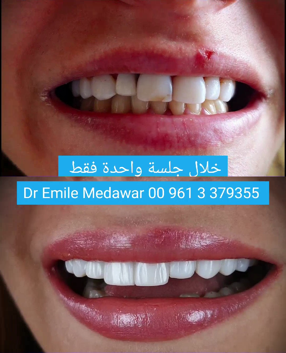 veneers price lebanon beirut