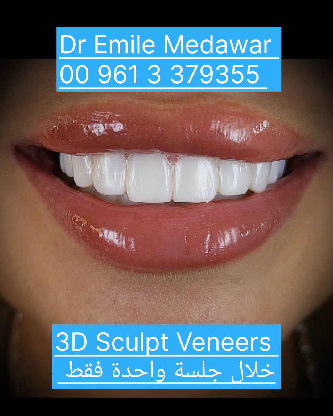 best hollywood smile in  lebanon beirut