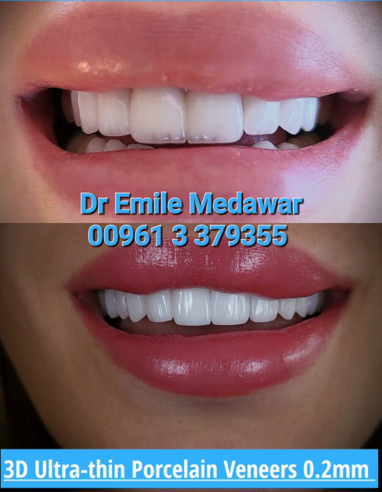 hollywood smile price lebanon beirut
